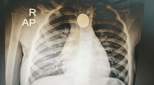 Niña salvada tras tragarse una moneda en Roque Alonso