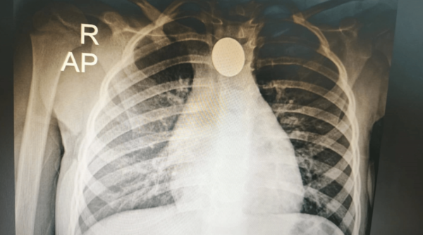 Niña salvada tras tragarse una moneda en Roque Alonso