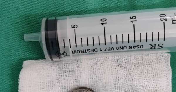 La Nación / Niña de tres años tragó moneda de G. 100 y fue salvada por médicos del Ineram