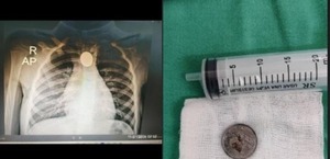 Extraen moneda atascada del esófago de una niña de 3 años