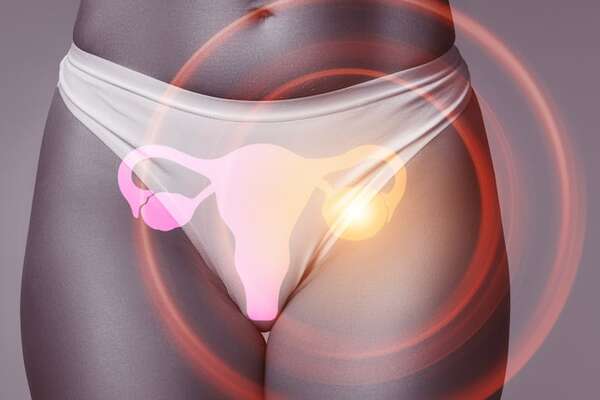 Decidir con información: por qué la ooforectomía no es una cirugía “menor” pero tampoco una condena - Sexualidad - ABC Color