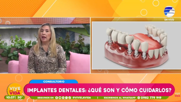 Implantes dentales: ¿Qué son y cómo cuidarlos?