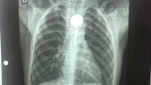 Carlos Morínigo se ofrece a capacitar al personal de blanco del Chaco tras caso de niño con moneda atascada