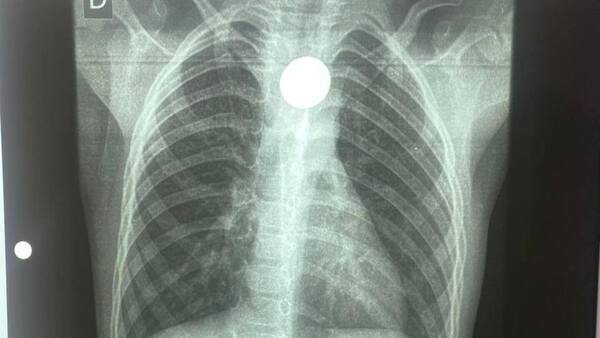 Carlos Morínigo se ofrece a capacitar al personal de blanco del Chaco tras caso de niño con moneda atascada