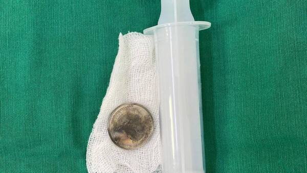 Niña de 9 años tragó una moneda de G. 1.000 y fue auxiliada a tiempo