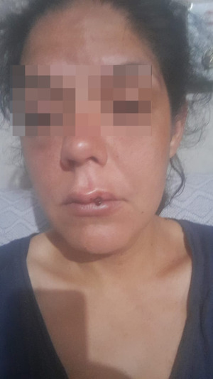 Popular / Mujer brutalmente golpeada por su pareja clama por justicia