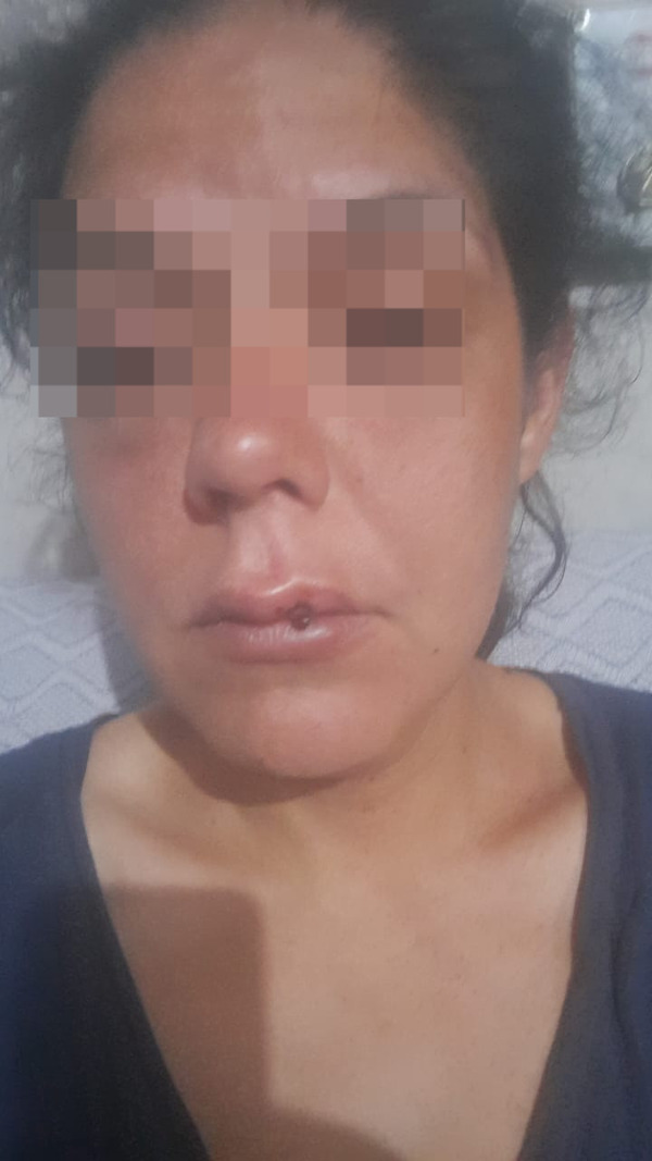 Popular / Mujer brutalmente golpeada por su pareja clama por justicia