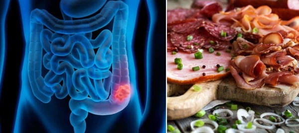 Carnes procesadas y cáncer: La advertencia de la OMS