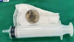 Intervienen a niña de 9 años que tragó moneda