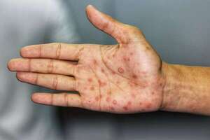 La sífilis ya circulaba en América hace 5.500 años, según estudio - Ciencia - ABC Color