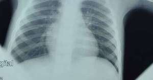 Diario HOY | En una semana, 4 niños fueron intervenidos por aspirar moneda