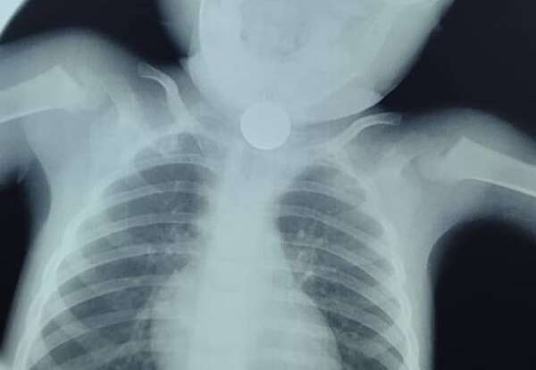 Ineram reporta cuatro casos de niños que tragaron monedas en lo que va del año - Nacionales - ABC Color