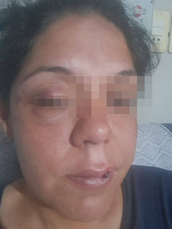 Mujer que sufrió agresión por parte de su ex pareja reclama justicia