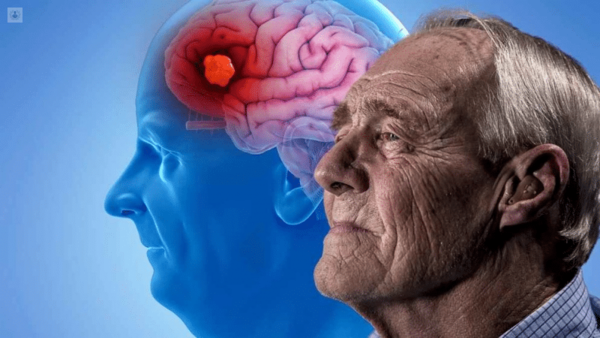 Análisis de sangre detecta el Alzheimer con 90% de éxito
