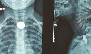 En solo una semana, 4 niños fueron intervenidos en el Ineram por aspirar monedas - OviedoPress