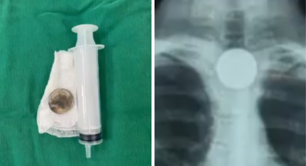 Niño se atragantó con una moneda y fue trasladado de urgencia a Asunción - SNT