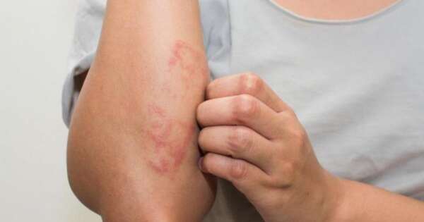 Diario HOY | Lepra: una enfermedad curable y con tratamiento gratuito