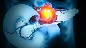 Investigador valora estudio experimental para el tratamiento del cáncer de páncreas