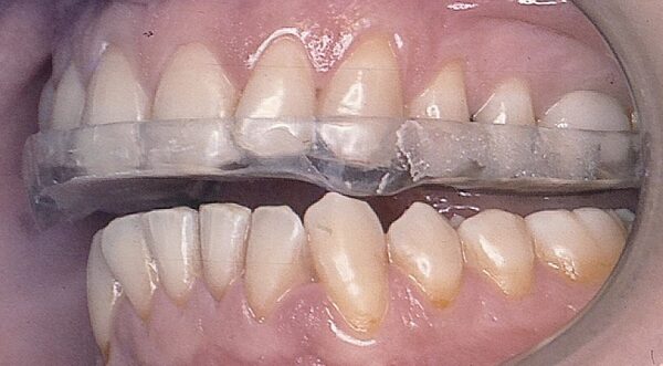 Expertos advierten de que el bruxismo puede manifestarse con mayor frecuencia en enero debido al estrés