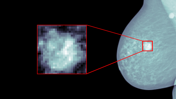 IA detecta 81% de cáncer de mama según estudio de The Lancet