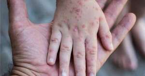 La Nación / Brote de sarampión ya supera los 850 casos en Carolina del Sur