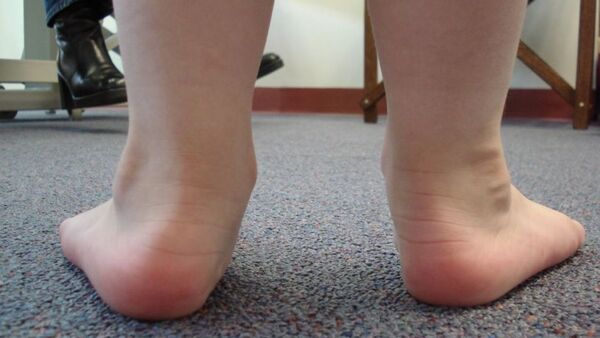 Pie plano en niños: qué es, cuándo es normal y cómo cuidarlo