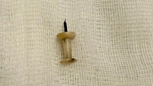 Extraen clavo que fue aspirado por un joven hace 4 años en Encarnación