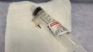 Adolescente de 15 años pasó cuatro años con un pinche atorado en su pulmón