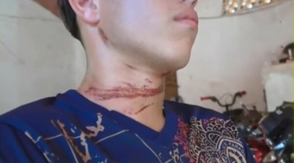 Popular / Cable suelto mortal: Uno casi fue degollado y otro ojegolpeapaite