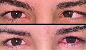 FCM-UNA realiza por primera vez un trasplante muscular para corregir estrabismo severo » San Lorenzo PY