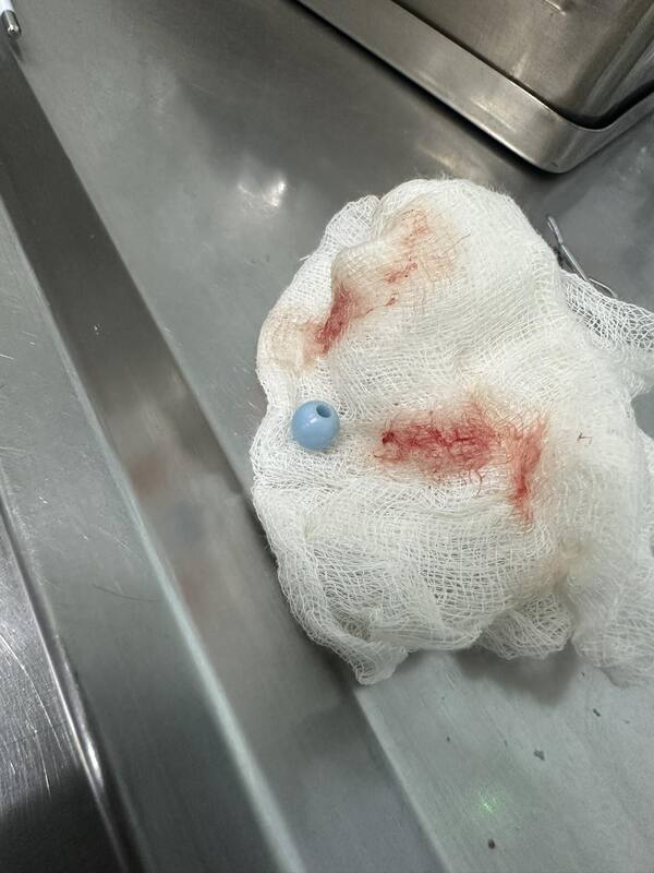 Extraen perlita de nariz de niña