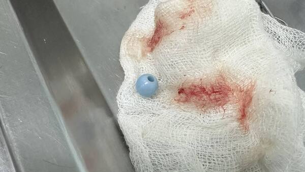 Sacaron una perlita de la nariz de una nena de 3 añitos