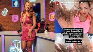 Marly Figueredo usó inyectable para bajar de peso y se le cayó a full su pelo