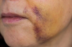 Popular / No aceptó volver con su ex y fue molida a golpes