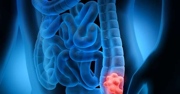 La Nación / Preocupa el aumento del cáncer colorrectal en menores de 50 años