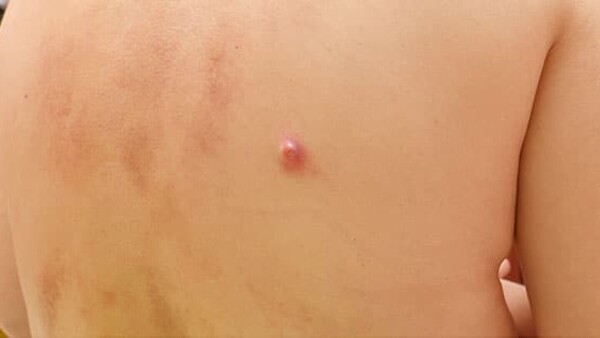 El susu’a: una infección frecuente que muchos no tratan a tiempo