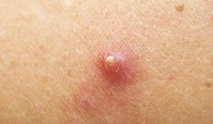 Especialista explica qué es realmente el forúnculo o susu'a | Unicanal