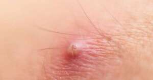 Diario HOY | Explican cómo se produjo muerte por un susu’a (forúnculo) y qué hacer si aparece uno