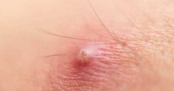 Diario HOY | Explican cómo se produjo muerte por un susu’a (forúnculo) y qué hacer si aparece uno