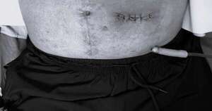 La Nación / IPS Ingavi realiza con éxito compleja cirugía intestinal mínimamente invasiva