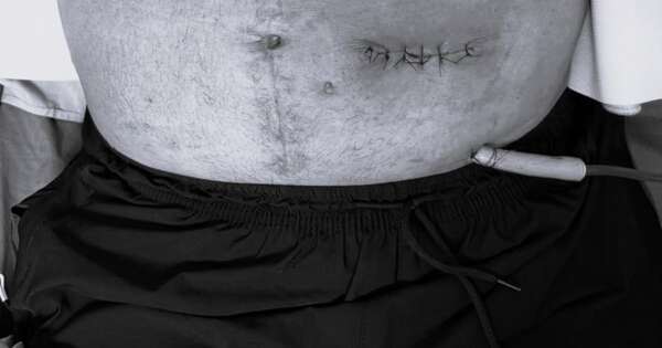 La Nación / IPS Ingavi realiza con éxito compleja cirugía intestinal mínimamente invasiva