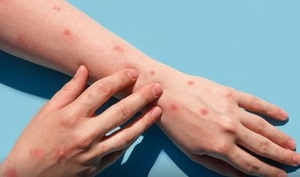 Confirman viruela del mono en Foz de Yguazú: paciente estaría residiendo en CDE | Unicanal