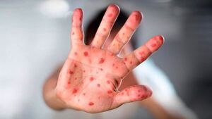 Salud Pública alista nueva campaña contra el sarampión