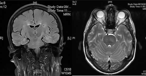 La Nación / Encefalopatía hipertensiva, una de las formas más graves de la presión alta
