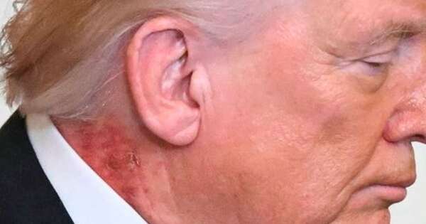 Diario HOY | Trump es visto con una gran mancha roja en el cuello