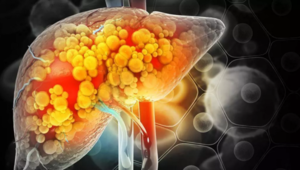 Experto alerta sobre daños del hígado por malos hábitos