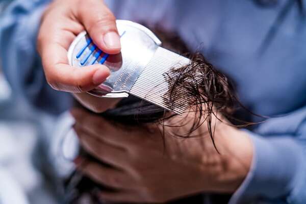 Atención: el peine fino no es suficiente para eliminar los piojos - Estilo de vida - ABC Color