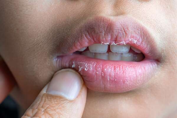 Labios siempre secos: por qué el bálsamo y el agua no bastan y cómo solucionarlo - Estilo de vida - ABC Color