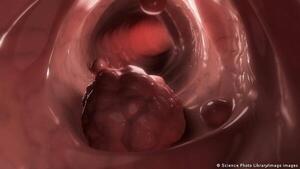 Tumor colorrectal se consolida como una de las principales causas de muerte en Paraguay