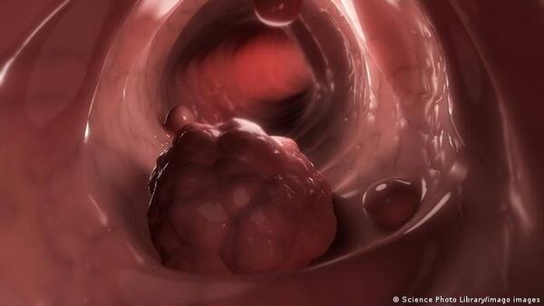 Tumor colorrectal se consolida como una de las principales causas de muerte en Paraguay